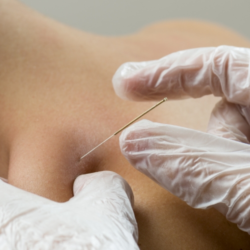 physical-therapy-clinic-dry-needling-arvada-physical-therapy-arvada-co